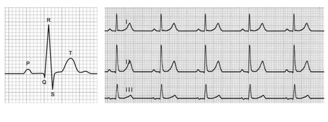 Ниже представлена фотография фрагмента электрокардиограммы и увеличенный снимок одного из сердечных