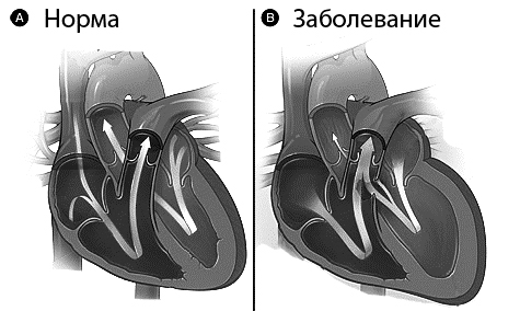 Рассмотрите рисунок с изображением схемы сердца человека как называют нарушение изображенное справа